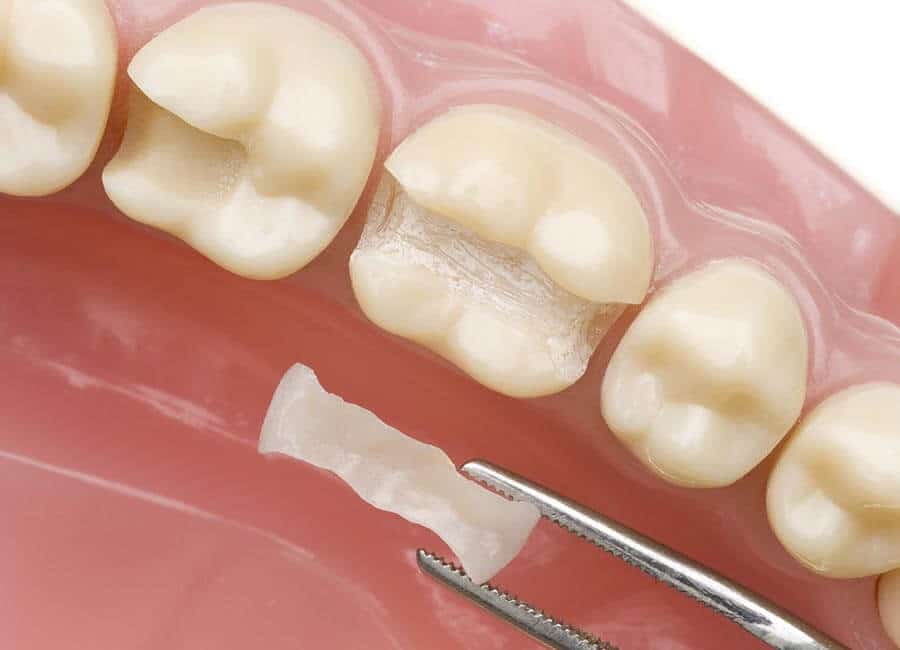 Cosmetic Restoration for Teeth