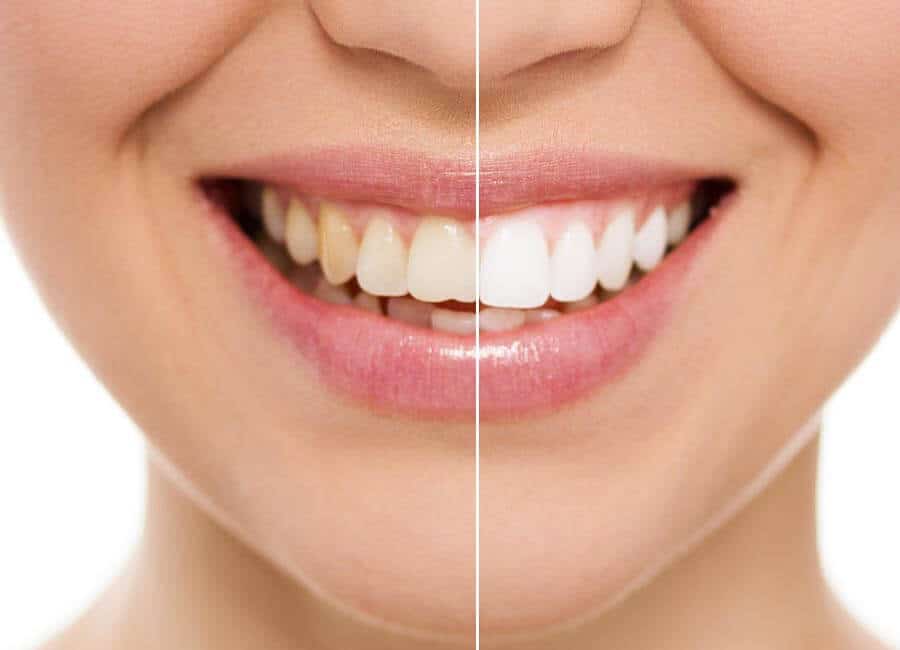 The Difference in Teeth Whitening