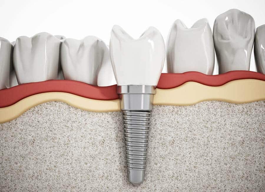 Dental Implants