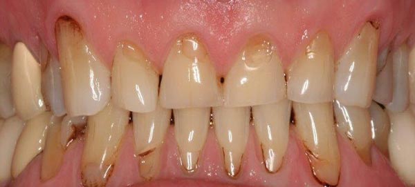 Serious Plaque and Decay of Teeth