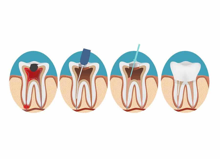 Root Canal Process guildford geotagged